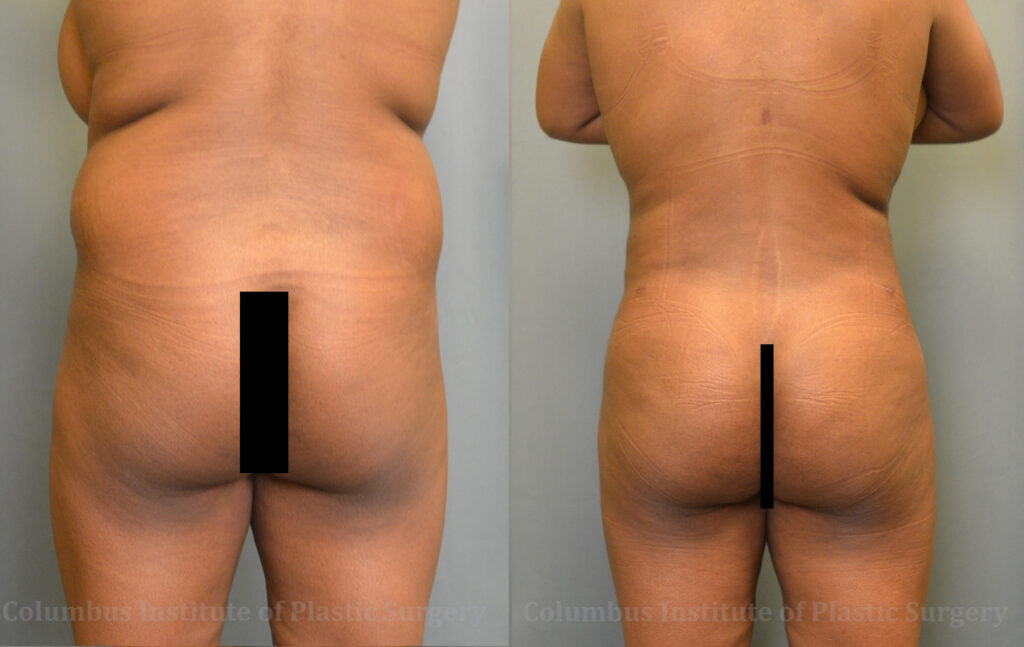 Gluteal (Butt) Augmentation with Fat Grafting (Brazilian Butt Lift) before and after photo by Columbus Institute of Plastic Surgery in Columbus, OH