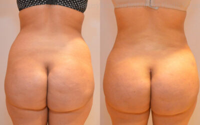 Gluteal (Butt) Augmentation with Fat Grafting (Brazilian Butt Lift) before and after photo by Columbus Institute of Plastic Surgery in Columbus, OH Gluteal (Butt) Augmentation with Fat Grafting (Brazilian Butt Lift) before and after photo by Columbus Institute of Plastic Surgery in Columbus, OH