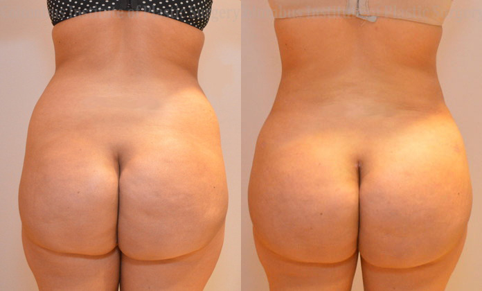 Gluteal (Butt) Augmentation with Fat Grafting (Brazilian Butt Lift) before and after photo by Columbus Institute of Plastic Surgery in Columbus, OH