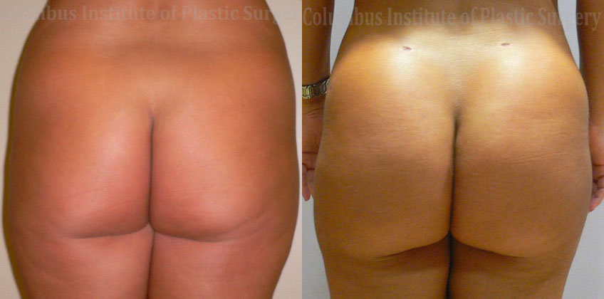 Gluteal (Butt) Augmentation with Fat Grafting (Brazilian Butt Lift) before and after photo by Columbus Institute of Plastic Surgery in Columbus, OH