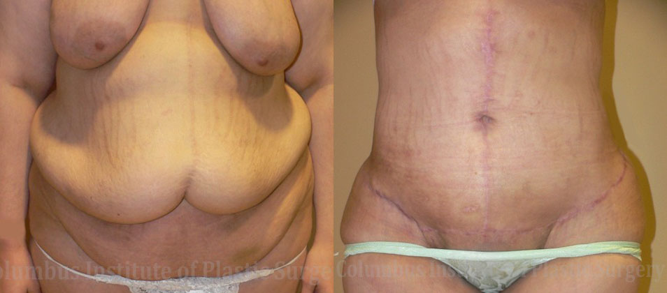 Abdominoplasty after Weight Loss before and after photo by Columbus Institute of Plastic Surgery in Columbus, OH