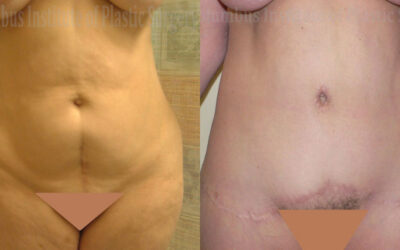 Belt Lipectomy before and after photo by Columbus Institute of Plastic Surgery in Columbus, OH Belt Lipectomy before and after photo by Columbus Institute of Plastic Surgery in Columbus, OH