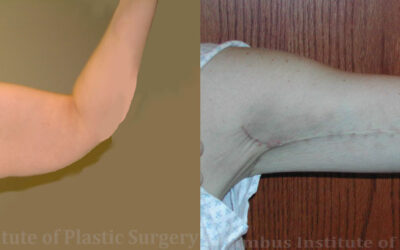 Brachioplasty (Arm Lift) before and after photo by Columbus Institute of Plastic Surgery in Columbus, OH Brachioplasty (Arm Lift) before and after photo by Columbus Institute of Plastic Surgery in Columbus, OH