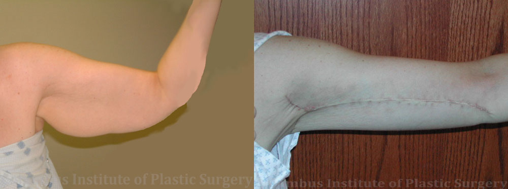 Brachioplasty (Arm Lift) before and after photo by Columbus Institute of Plastic Surgery in Columbus, OH