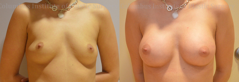 Breast Augmentation – 200cc-300cc before and after photo by Columbus Institute of Plastic Surgery in Columbus, OH