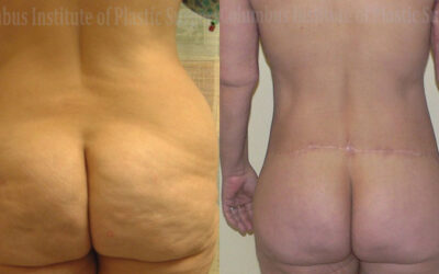 Belt Lipectomy before and after photo by Columbus Institute of Plastic Surgery in Columbus, OH Belt Lipectomy before and after photo by Columbus Institute of Plastic Surgery in Columbus, OH
