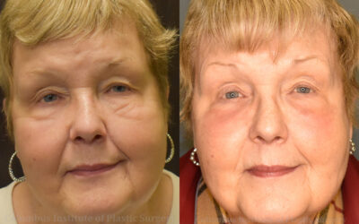 Laser Skin Resurfacing before and after photo by Columbus Institute of Plastic Surgery in Columbus, OH Laser Skin Resurfacing before and after photo by Columbus Institute of Plastic Surgery in Columbus, OH