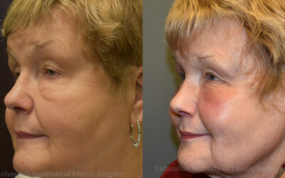 Laser Skin Resurfacing before and after photo by Columbus Institute of Plastic Surgery in Columbus, OH Laser Skin Resurfacing before and after photo by Columbus Institute of Plastic Surgery in Columbus, OH