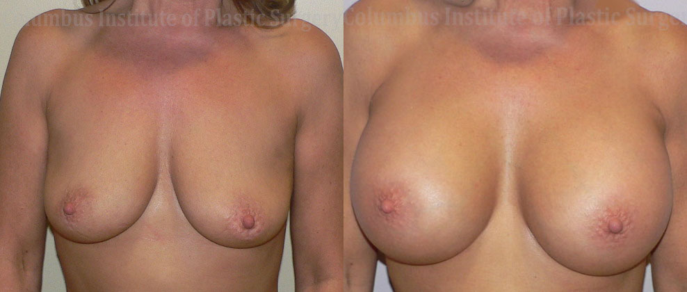 Breast Augmentation – 400cc-500cc before and after photo by Columbus Institute of Plastic Surgery in Columbus, OH