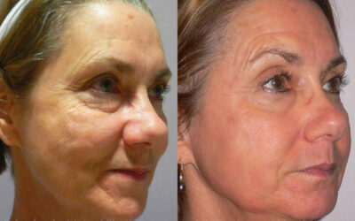 Laser Skin Resurfacing before and after photo by Columbus Institute of Plastic Surgery in Columbus, OH Laser Skin Resurfacing before and after photo by Columbus Institute of Plastic Surgery in Columbus, OH