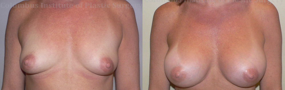 Breast Augmentation before and after photo by Columbus Institute of Plastic Surgery in Columbus, OH