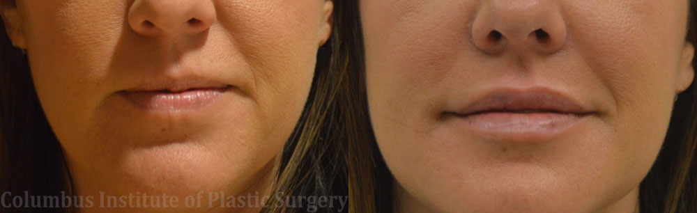 Lip Augmentation (Fillers and Implants) before and after photo by Columbus Institute of Plastic Surgery in Columbus, OH