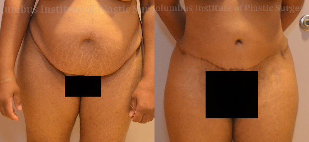 Abdominoplasty (Tummy Tuck) before and after photo by Columbus Institute of Plastic Surgery in Columbus, OH