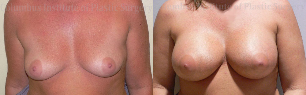 Breast Augmentation before and after photo by Columbus Institute of Plastic Surgery in Columbus, OH