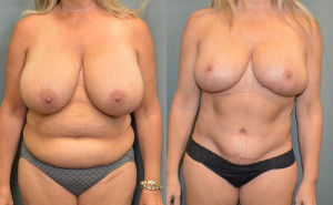 Abdominoplasty (Tummy Tuck) before and after photo by Columbus Institute of Plastic Surgery in Columbus, OH