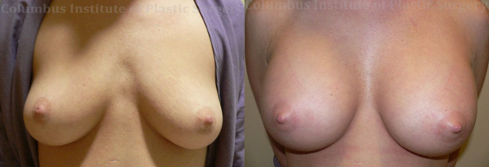Breast Augmentation before and after photo by Columbus Institute of Plastic Surgery in Columbus, OH