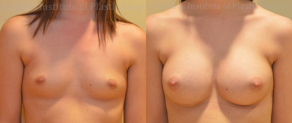 Breast Augmentation – 400cc-500cc before and after photo by Columbus Institute of Plastic Surgery in Columbus, OH