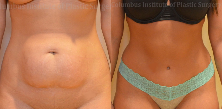 Abdominoplasty (Tummy Tuck) before and after photo by Columbus Institute of Plastic Surgery in Columbus, OH