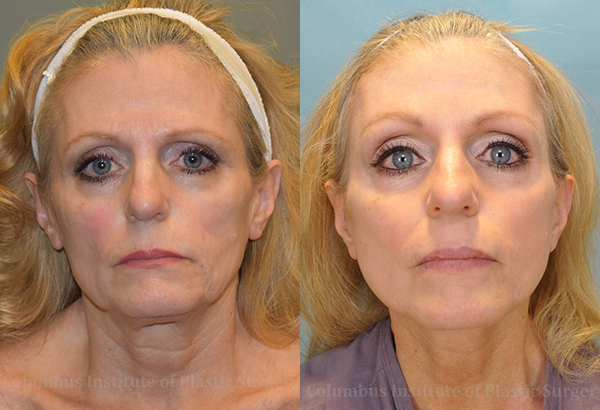 Mini Facelift before and after photo by Columbus Institute of Plastic Surgery in Columbus, OH