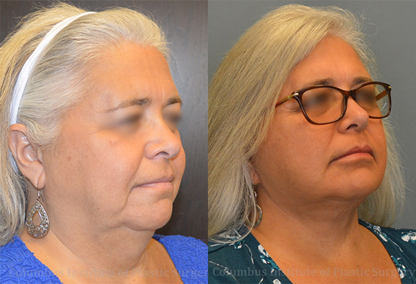 Mini Facelift before and after photo by Columbus Institute of Plastic Surgery in Columbus, OH Mini Facelift before and after photo by Columbus Institute of Plastic Surgery in Columbus, OH