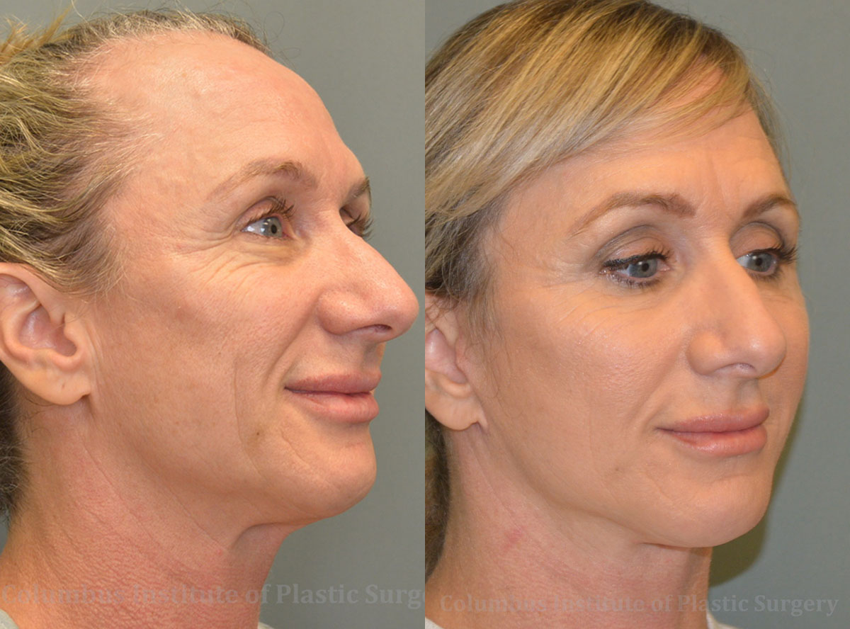Mini Facelift before and after photo by Columbus Institute of Plastic Surgery in Columbus, OH Mini Facelift before and after photo by Columbus Institute of Plastic Surgery in Columbus, OH