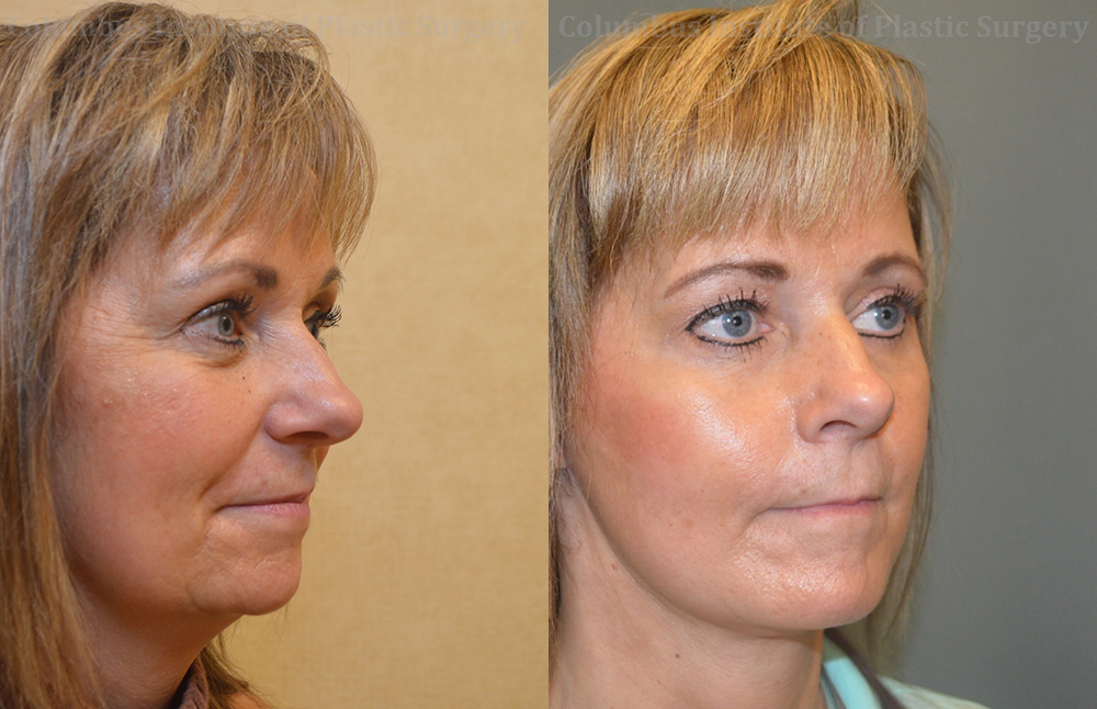 Mini Facelift before and after photo by Columbus Institute of Plastic Surgery in Columbus, OH Mini Facelift before and after photo by Columbus Institute of Plastic Surgery in Columbus, OH