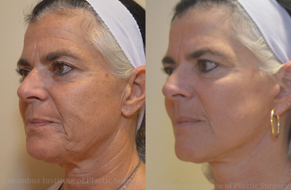 Mini Facelift before and after photo by Columbus Institute of Plastic Surgery in Columbus, OH Mini Facelift before and after photo by Columbus Institute of Plastic Surgery in Columbus, OH