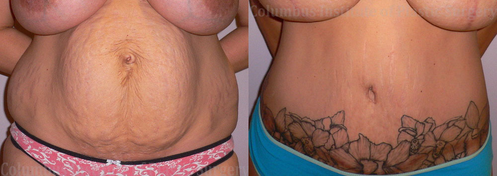 Abdominoplasty (Tummy Tuck) before and after photo by Columbus Institute of Plastic Surgery in Columbus, OH