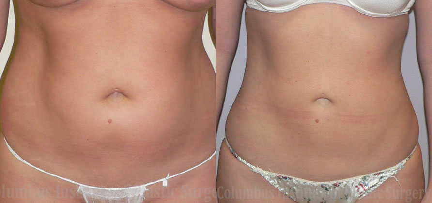 Liposuction before and after photo by Columbus Institute of Plastic Surgery in Columbus, OH