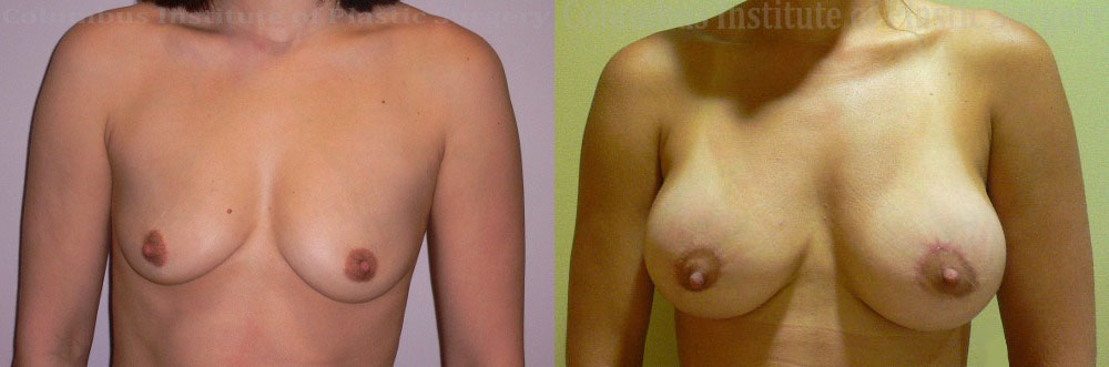 Mini Mastopexy and Augmentation (Breast Lift with Implants) before and after photo by Columbus Institute of Plastic Surgery in Columbus, OH