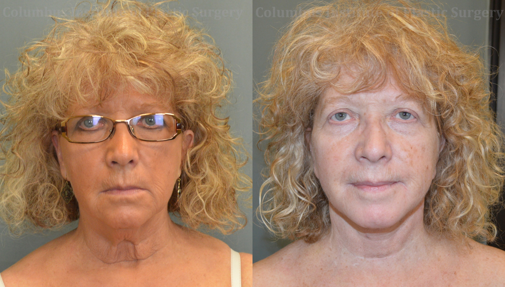 Necklift before and after photo by Columbus Institute of Plastic Surgery in Columbus, OH Necklift before and after photo by Columbus Institute of Plastic Surgery in Columbus, OH