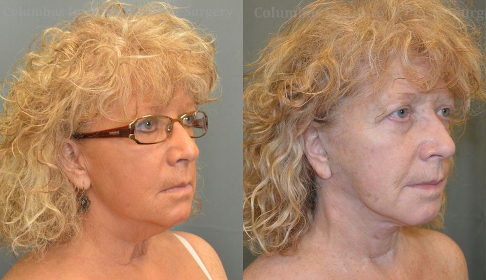 Necklift before and after photo by Columbus Institute of Plastic Surgery in Columbus, OH Necklift before and after photo by Columbus Institute of Plastic Surgery in Columbus, OH