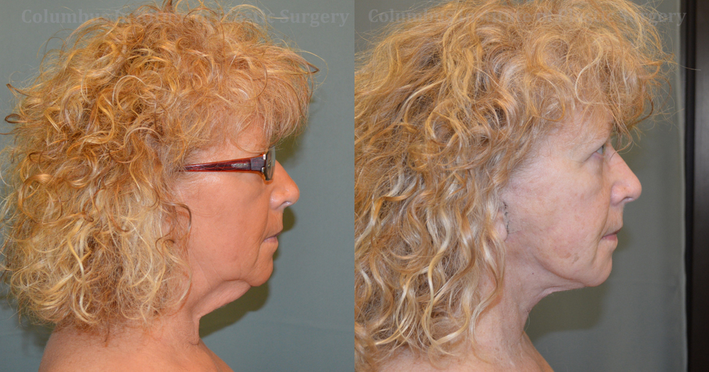 Necklift before and after photo by Columbus Institute of Plastic Surgery in Columbus, OH Necklift before and after photo by Columbus Institute of Plastic Surgery in Columbus, OH