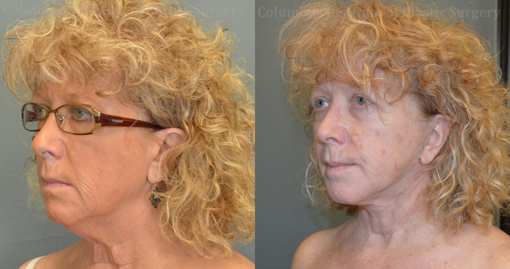Necklift before and after photo by Columbus Institute of Plastic Surgery in Columbus, OH Necklift before and after photo by Columbus Institute of Plastic Surgery in Columbus, OH