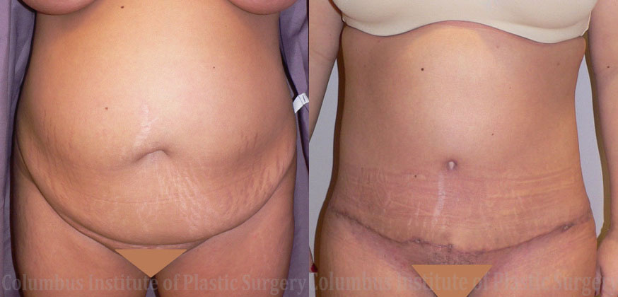 Abdominoplasty (Tummy Tuck) before and after photo by Columbus Institute of Plastic Surgery in Columbus, OH