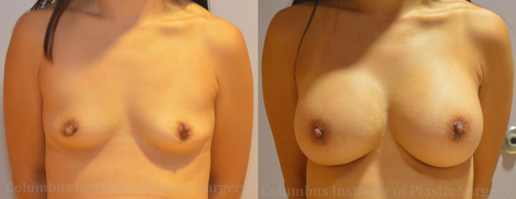 Breast Augmentation before and after photo by Columbus Institute of Plastic Surgery in Columbus, OH