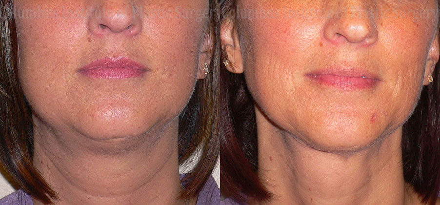 Liposuction before and after photo by Columbus Institute of Plastic Surgery in Columbus, OH