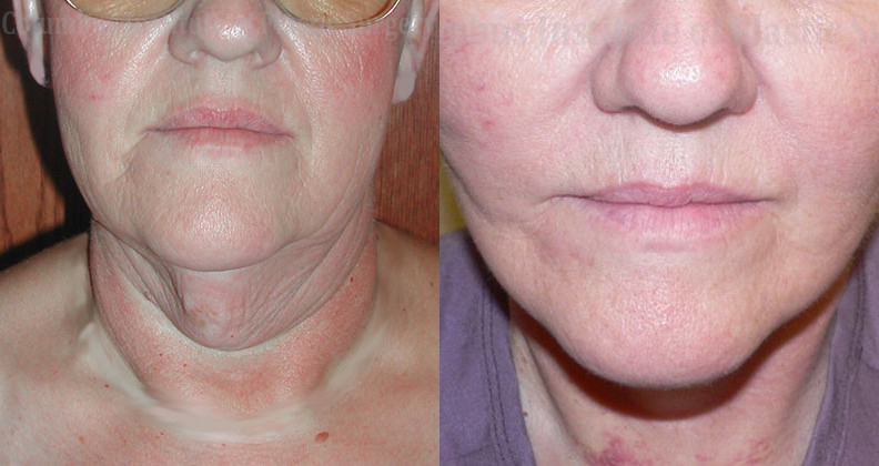 Necklift before and after photo by Columbus Institute of Plastic Surgery in Columbus, OH Necklift before and after photo by Columbus Institute of Plastic Surgery in Columbus, OH