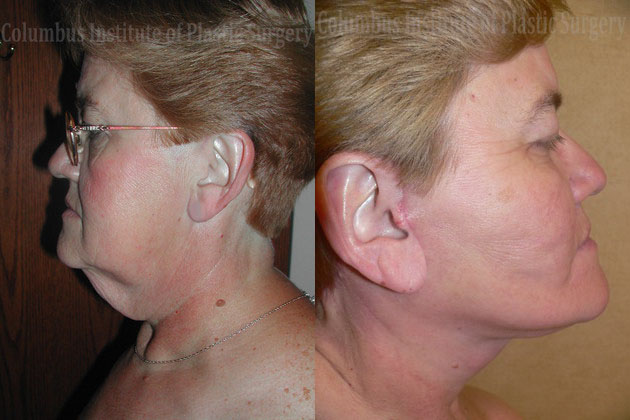 Necklift before and after photo by Columbus Institute of Plastic Surgery in Columbus, OH Necklift before and after photo by Columbus Institute of Plastic Surgery in Columbus, OH