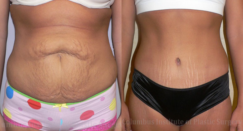 Abdominoplasty (Tummy Tuck) before and after photo by Columbus Institute of Plastic Surgery in Columbus, OH