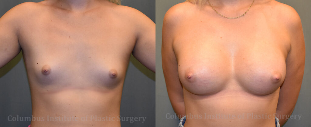 Breast Augmentation before and after photo by Columbus Institute of Plastic Surgery in Columbus, OH