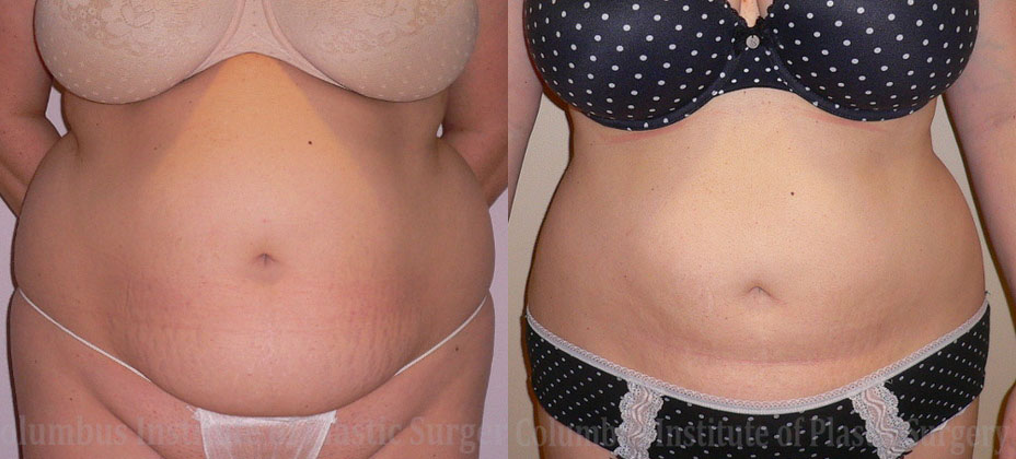 Liposuction before and after photo by Columbus Institute of Plastic Surgery in Columbus, OH