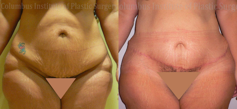 Panniculectomy before and after photo by Columbus Institute of Plastic Surgery in Columbus, OH