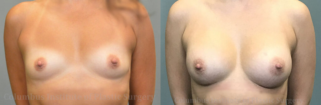 Breast Augmentation before and after photo by Columbus Institute of Plastic Surgery in Columbus, OH