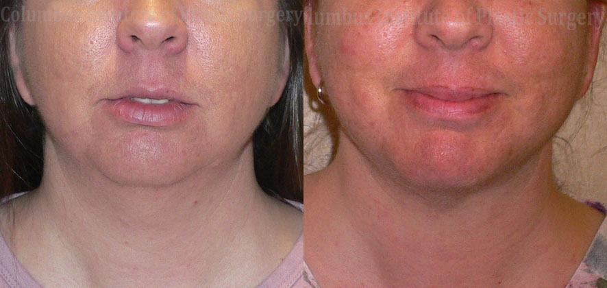 Liposuction before and after photo by Columbus Institute of Plastic Surgery in Columbus, OH