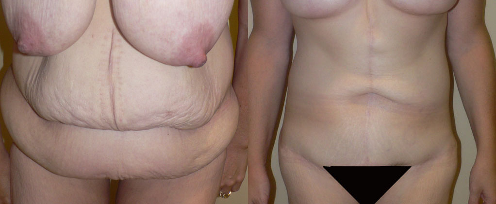 Abdominoplasty after Weight Loss before and after photo by Columbus Institute of Plastic Surgery in Columbus, OH