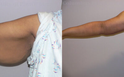 Brachioplasty (Arm Lift) before and after photo by Columbus Institute of Plastic Surgery in Columbus, OH Brachioplasty (Arm Lift) before and after photo by Columbus Institute of Plastic Surgery in Columbus, OH