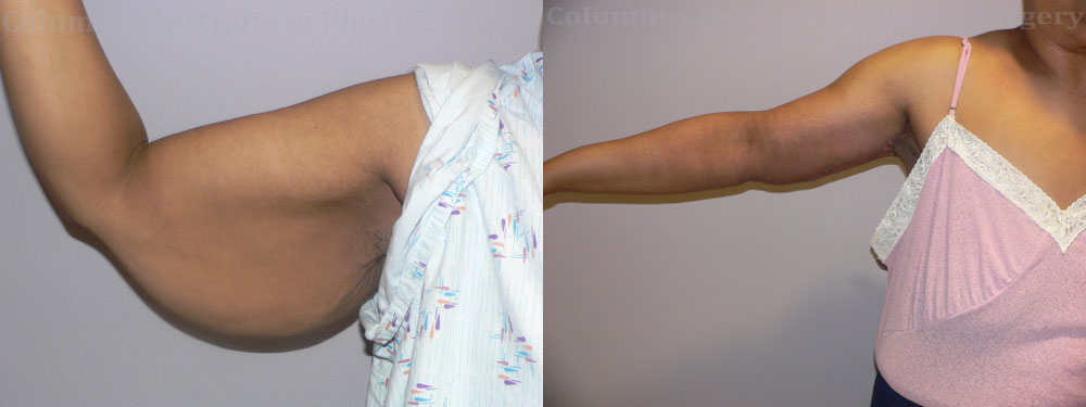 Brachioplasty (Arm Lift) before and after photo by Columbus Institute of Plastic Surgery in Columbus, OH