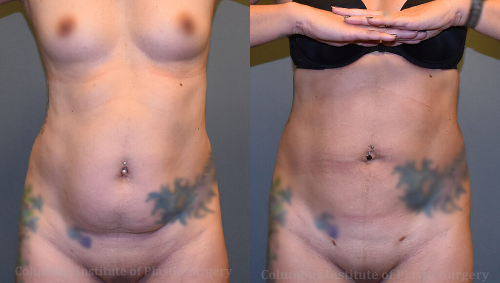 Liposuction before and after photo by Columbus Institute of Plastic Surgery in Columbus, OH