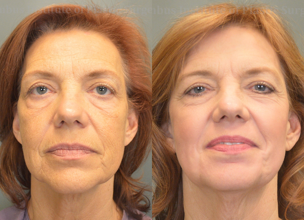 Phenol Chemical Peel before and after photo by Columbus Institute of Plastic Surgery in Columbus, OH